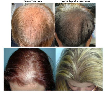 Exosome Therapy for Hair Loss/Thinning